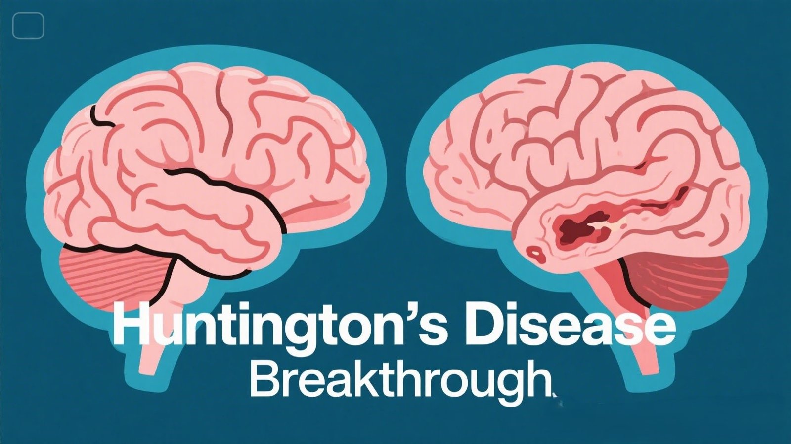 Huntington’s Disease Gene Therapy Breakthrough